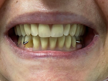 Corrected Bite!