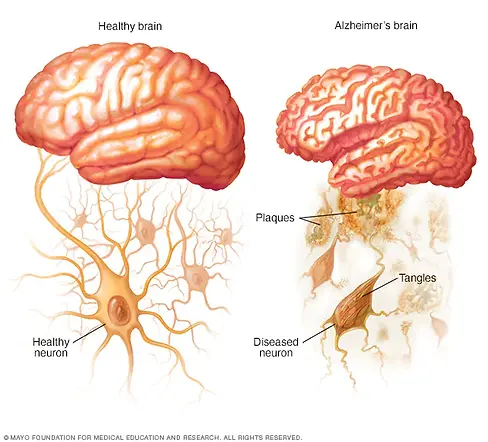 healthy-brain-and-brain-with-alzheimers-8-col-3398230-002-0.webp