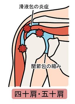 五十肩のイメージ