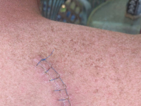 Drews Mole Removal