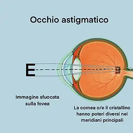 L’astigmatismo è un difetto visivo causato da un’irregolarità nella curvatura della cornea o del cristallino che provoca una messa a fuoco imperfetta delle immagini sulla retina. La persona con astigmatismo percepisce gli oggetti sia vicini che lontani in modo sfocato o distorto. Questa condizione può essere presente dalla nascita e si manifesta spesso in combinazione con miopia o ipermetropia.
