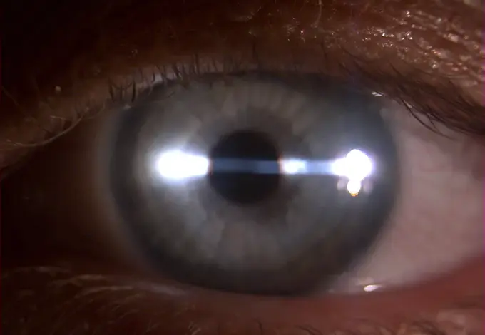 Cheratocono – Codice esenzione RF0280