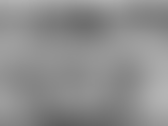 Understanding Impacted Canines: Causes and Prevention Strategies