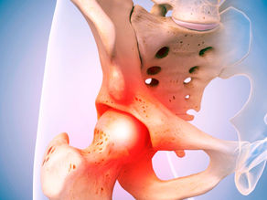 Hip replacement surgery