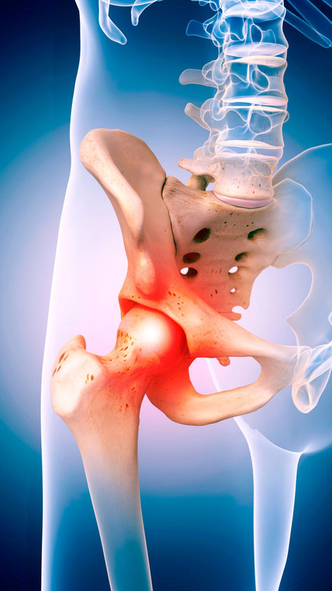 Hip replacement surgery