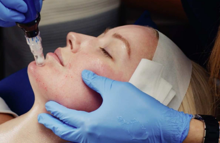 What Is Microneedling Good For? Benefits, Results & Why It’s Worth Trying
