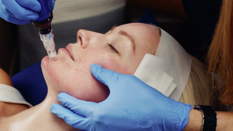 What Is Microneedling Good For? Benefits, Results & Why It’s Worth Trying
