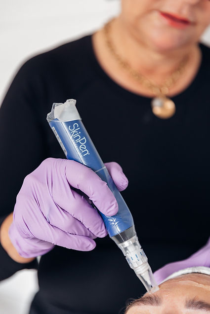 Microneedling Treatment Poole