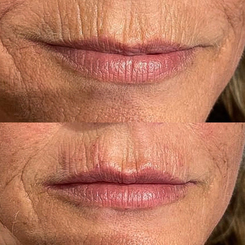 Lip Fillers Bournemouth