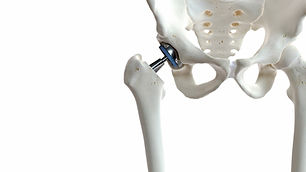 Mr Simon Garrett Hip Replacement Dorset.