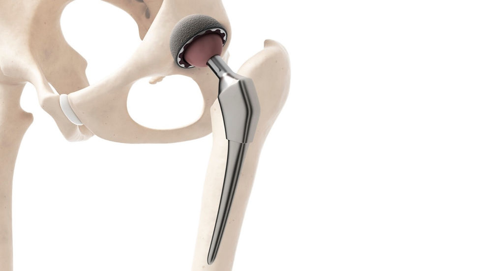 Mr Simon Garrett Hip Replacement Dorset.