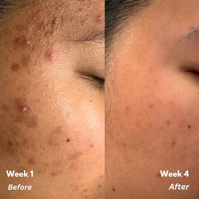 2% Salicylic Acid Toner & Serum
