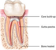 Root Canal Treatment Right.jpg