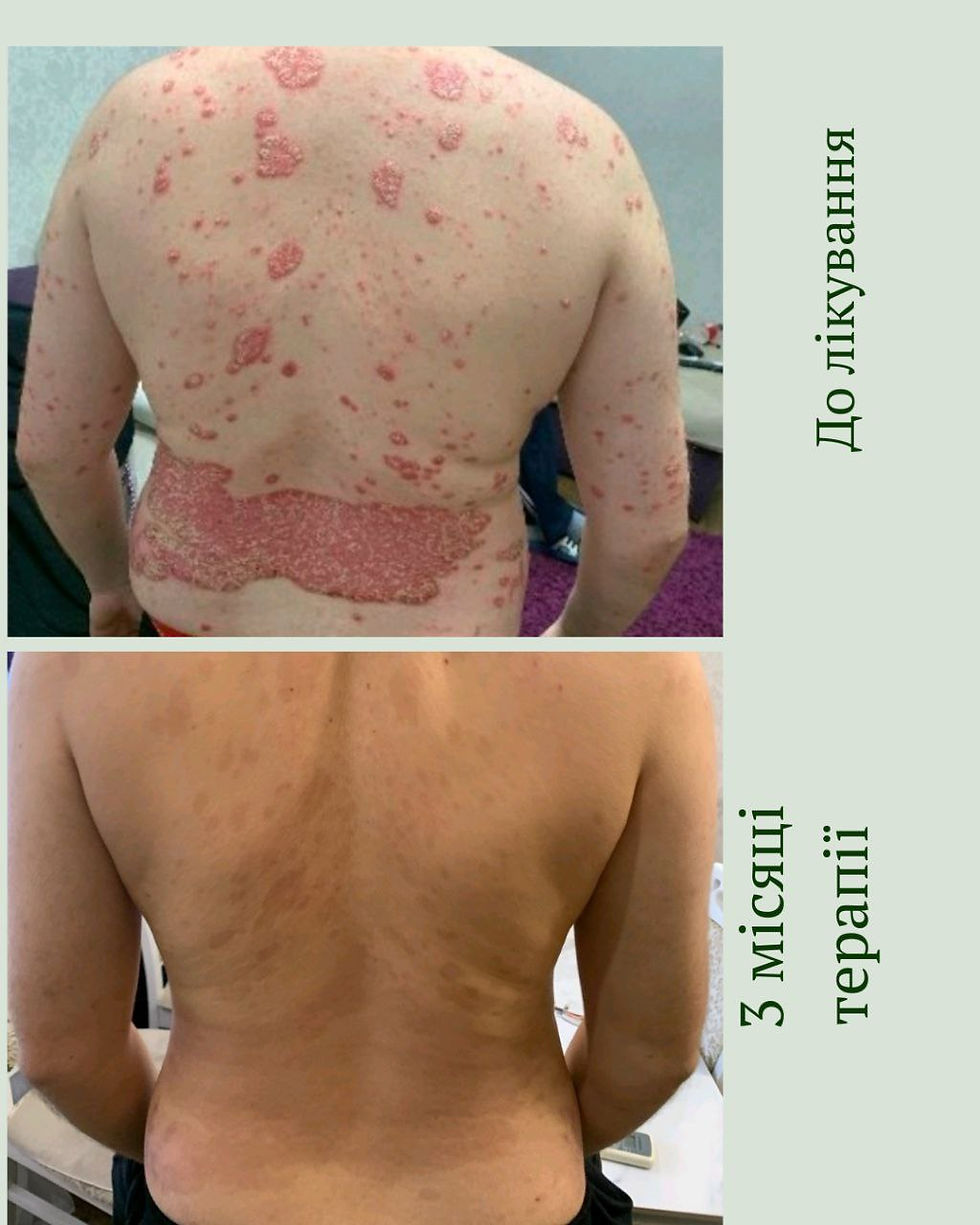 Від гормонів до натурального одужання: реальний клінічний випадок лікування псоріазу