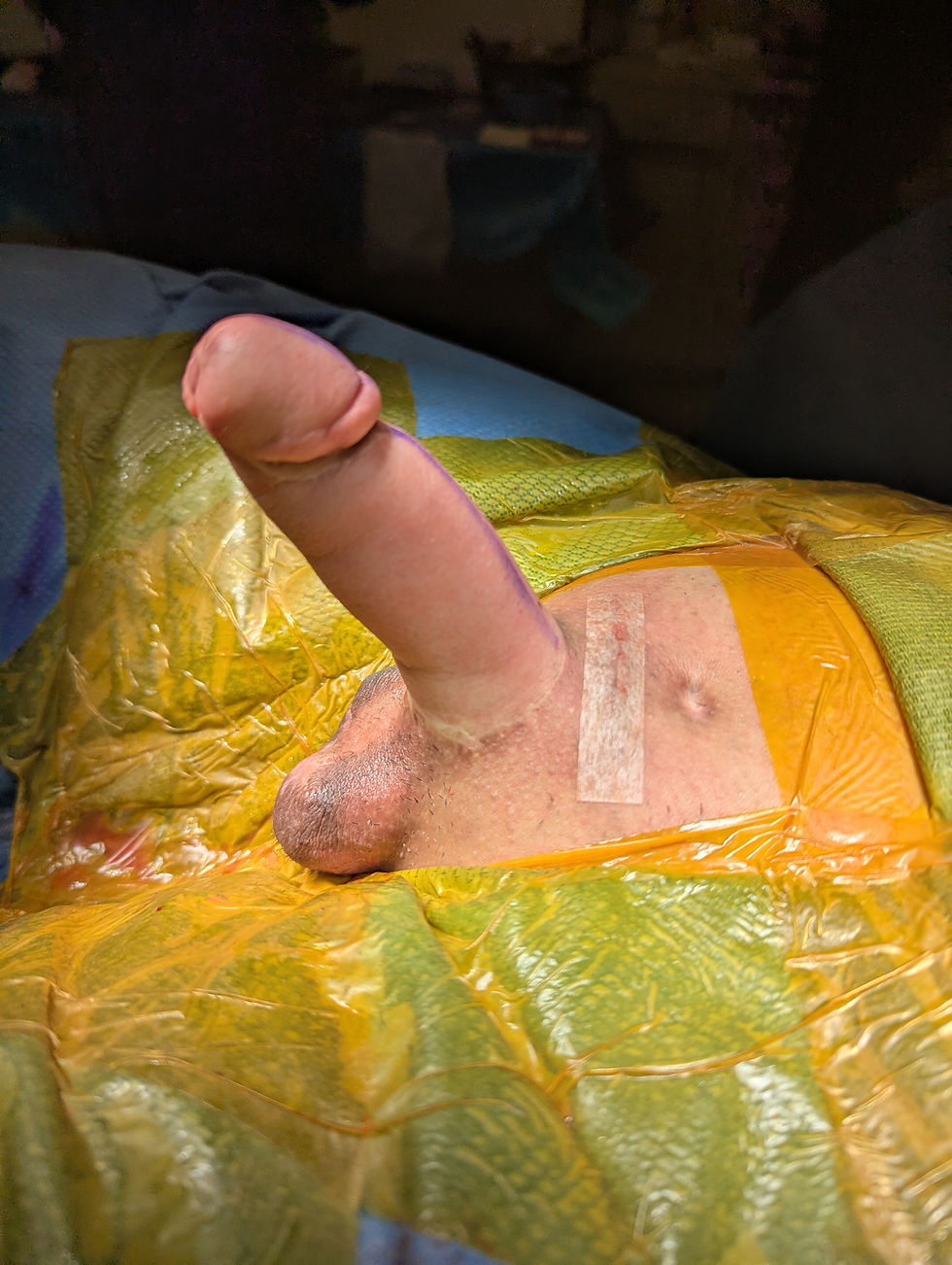 Inflatable Penile Prosthesis immediate postop photo