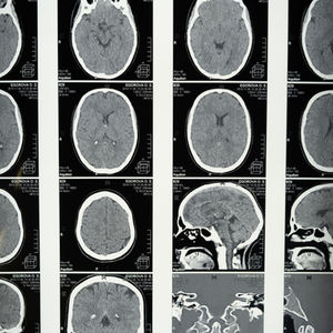 What is Neuropsychology?