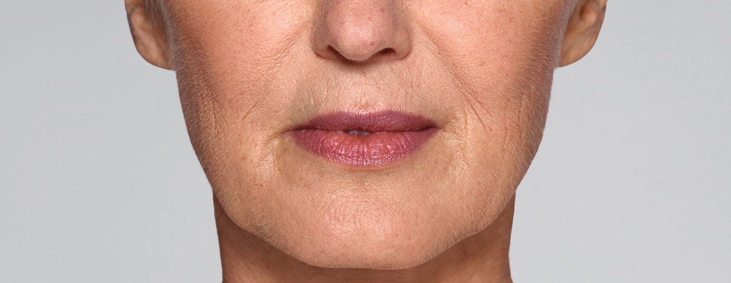 Restylane Refyne in Springfield, IL Rose Aesthetics & Wellness Clinic