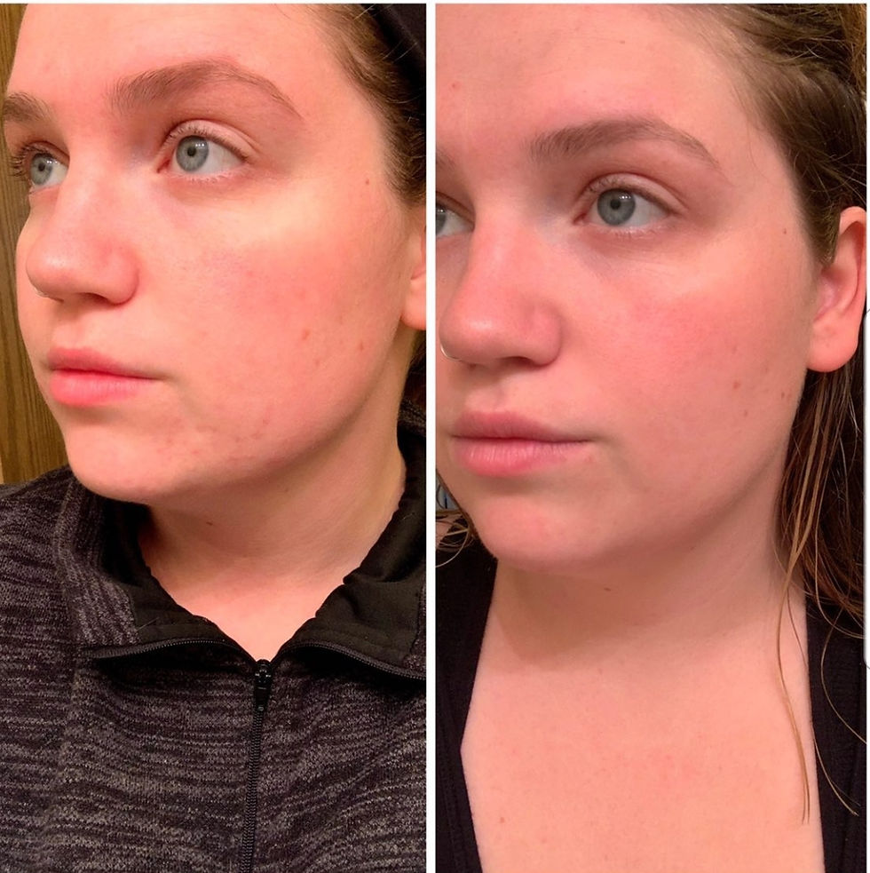 Thumbnail: Organic Rose Oil | Hydrating | Anti-Scarring | Anti-Inflammatory