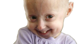 Progeria, malattia dei «nati vecchi»