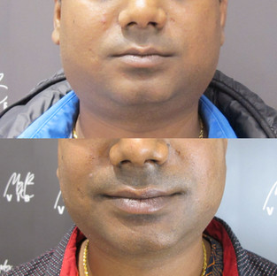 double chin reduction