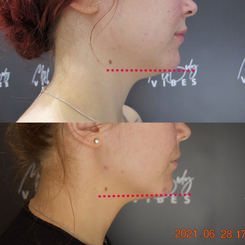 ulfit double chin