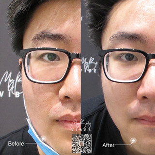 hydra facial
