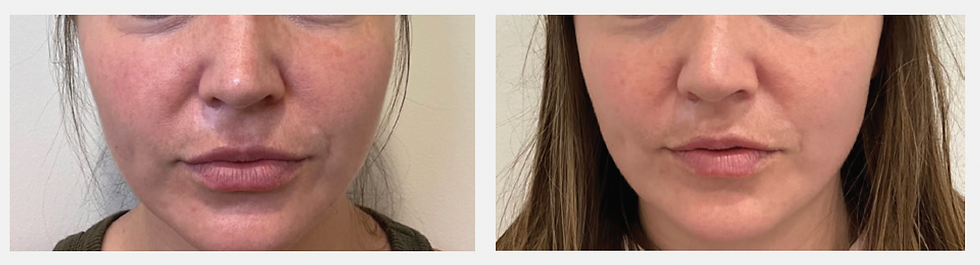 Thumbnail: Opuluxe V Skin Booster - Before and After - Image 3