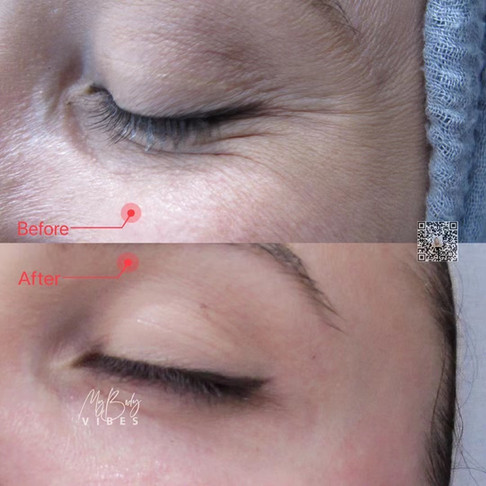 anti-wrinkle injection-crows feet