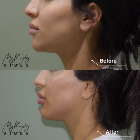 cheek filler