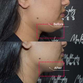 ulfit double chin reduction
