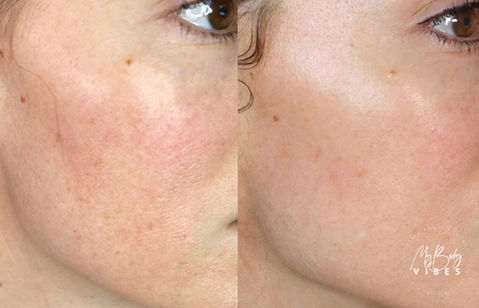 fractional rf micro needling