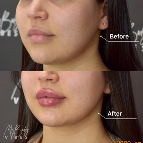 lip filler melbourne.jpeg