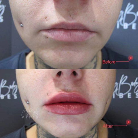 lip filler
