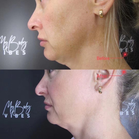 cheek filler