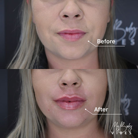 lip filler my body vibes