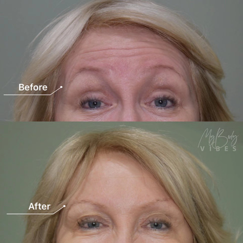 forehead anti-wrinkle