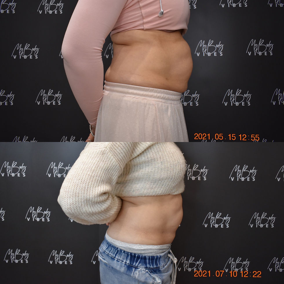Thumbnail: Fat Freezing - 2 Areas - Before and After - Image 4
