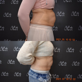fat freezing on abdomen
