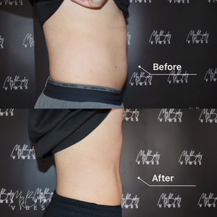 fat freezing on abdomen