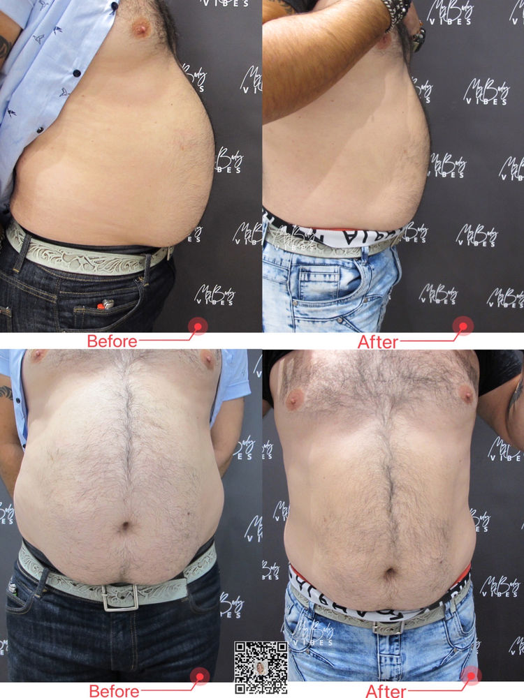 Liposuction Vs Fat Freezing, Which Is Better?