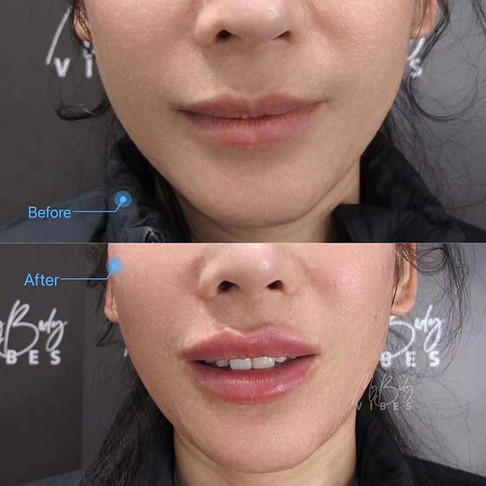 lip filler