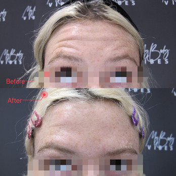 anti-wrinkle injection-forehead.jpeg