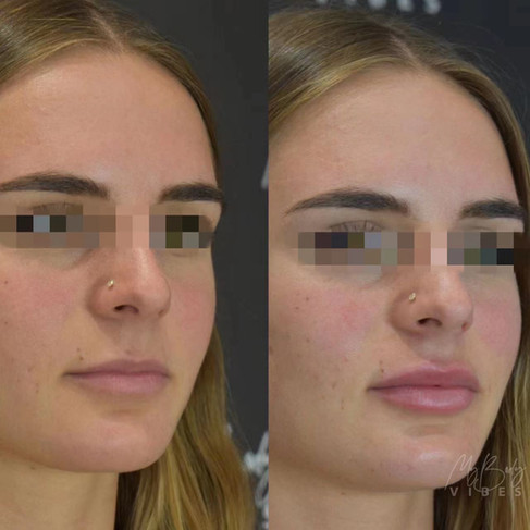 lip filler