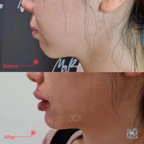 chin and lip filler
