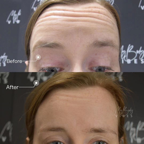 anti wrinkle forehead.jpeg
