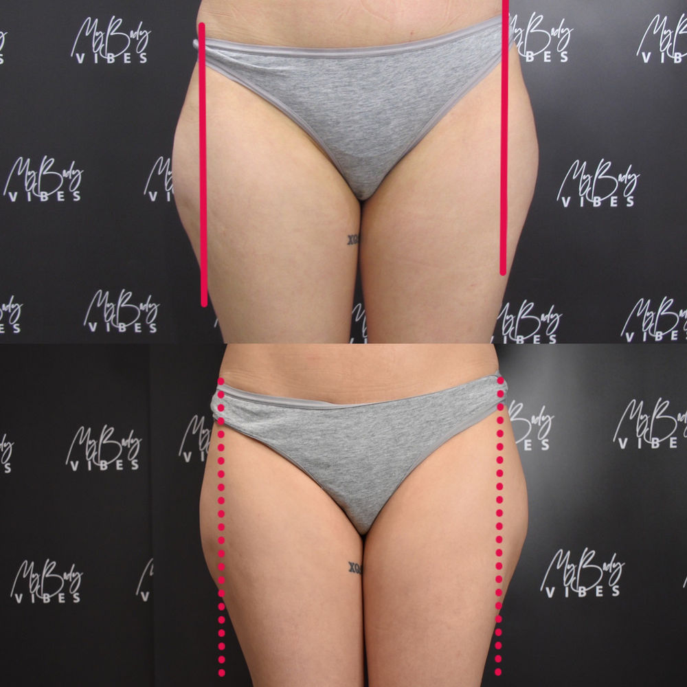get rid of outer thigh fat