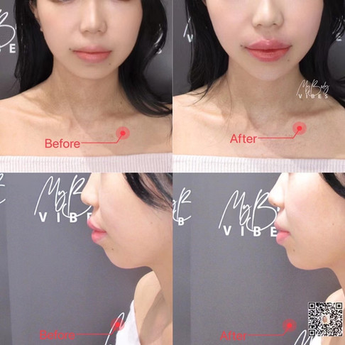 lip and chin filler