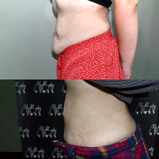 fat freezing on abdomen