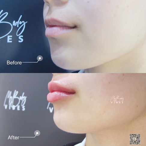 lip and chin filler