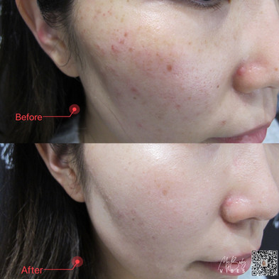 hydra boost facial